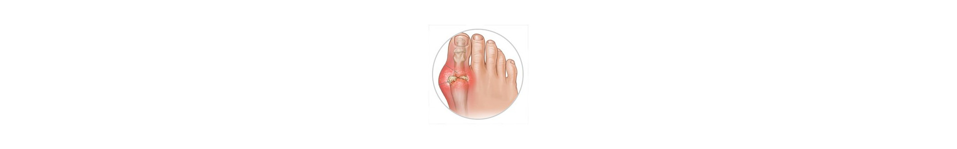 Gout, Podagra