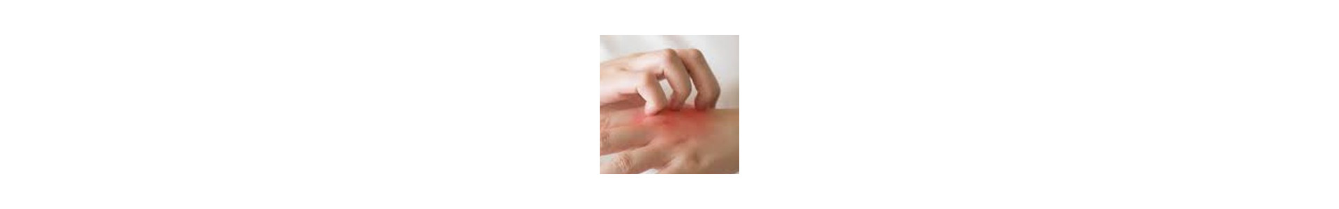 Psoriasis